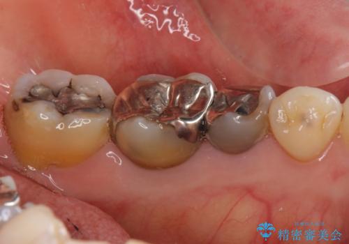 下の銀歯をセラミックに　虫歯治療の治療前