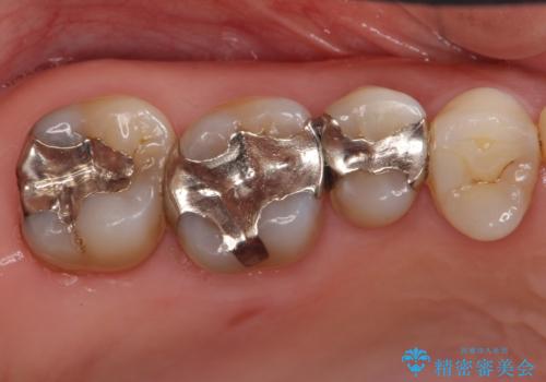 銀歯を白く　虫歯治療の症例 治療前