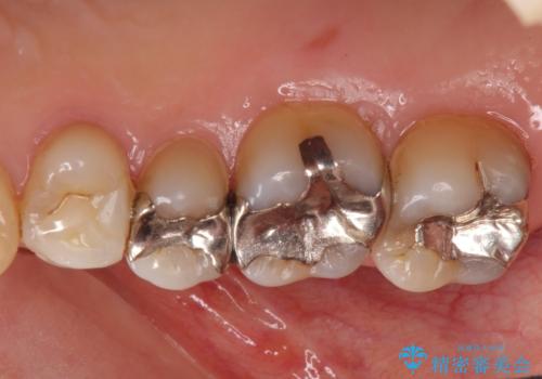 銀歯を白く　虫歯治療の治療前
