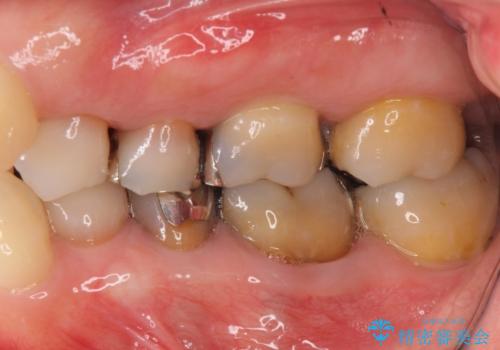 下の銀歯をセラミックに 虫歯治療の治療前