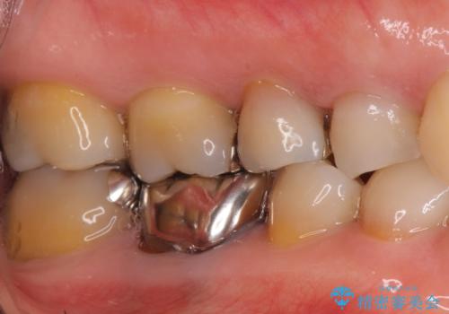 銀歯を白く　虫歯治療の治療前