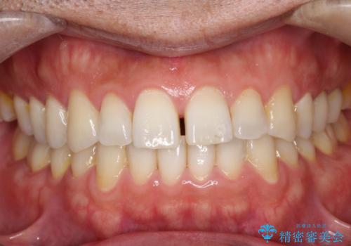 【インビザライン】前歯の隙間を閉じたいの症例 治療前