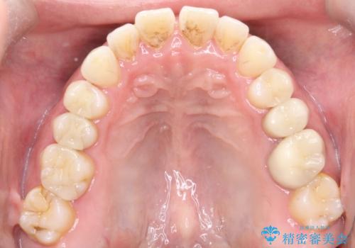 【インビザライン】前歯の隙間を閉じたいの治療前