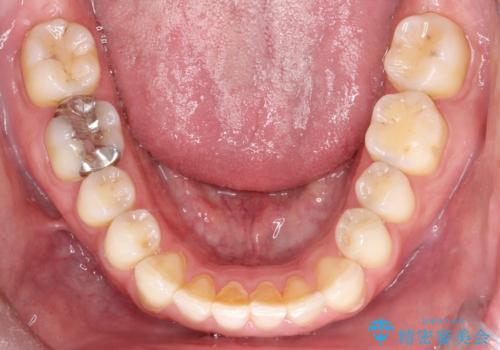 【インビザライン】前歯の隙間を閉じたいの治療前