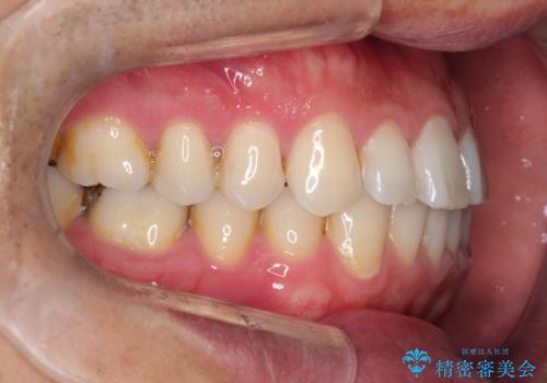 【インビザライン】前歯の隙間を閉じたいの治療前