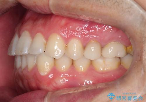 【インビザライン】前歯の隙間を閉じたいの治療前