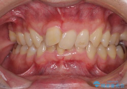 前歯が折れたついでに歯並びも改善　矯正治療と前歯のセラミック治療の症例 治療前
