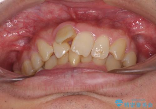 前歯が折れたついでに歯並びも改善　矯正治療と前歯のセラミック治療の治療前