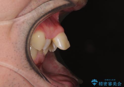 前歯が折れたついでに歯並びも改善 矯正治療と前歯のセラミック治療の治療前