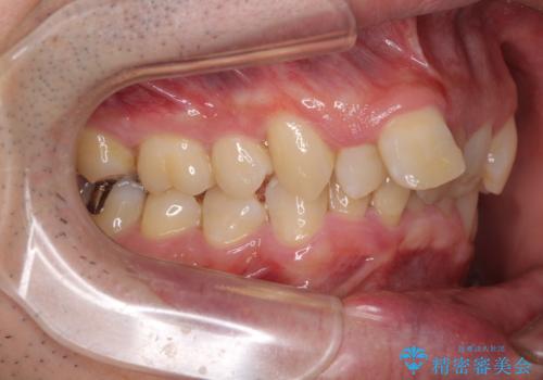 前歯が折れたついでに歯並びも改善 矯正治療と前歯のセラミック治療の治療前