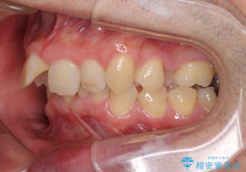 前歯が折れたついでに歯並びも改善 矯正治療と前歯のセラミック治療の治療前