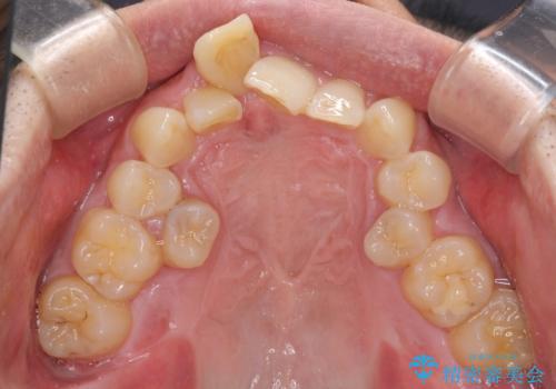 前歯が折れたついでに歯並びも改善 矯正治療と前歯のセラミック治療の治療前