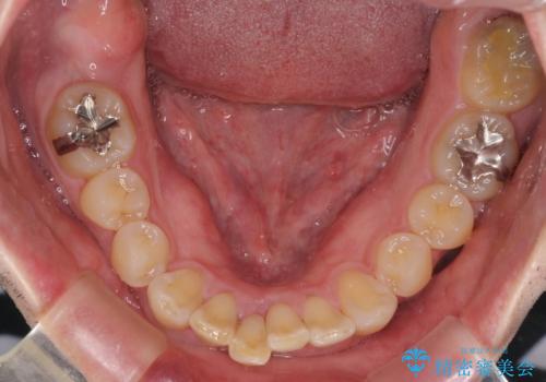 前歯が折れたついでに歯並びも改善　矯正治療と前歯のセラミック治療の治療前