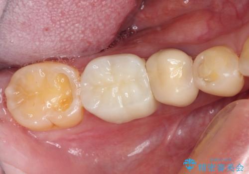 奥歯が欠けてしまった オールセラミッククラウンによる補綴治療の治療後