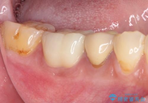 奥歯が欠けてしまった オールセラミッククラウンによる補綴治療の治療後
