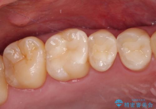 詰め物が外れた セラミックインレー修復の治療後
