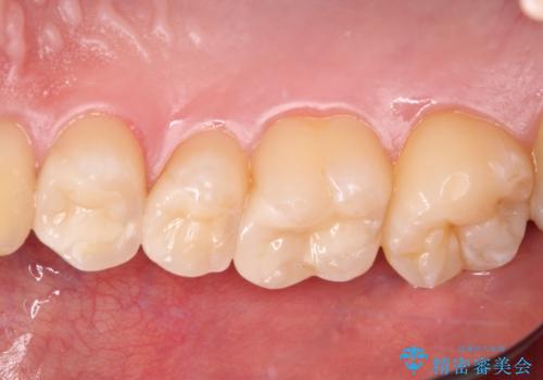 詰め物が外れた セラミックインレー修復の治療後