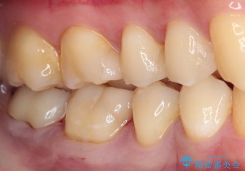 詰め物が外れた セラミックインレー修復の治療後