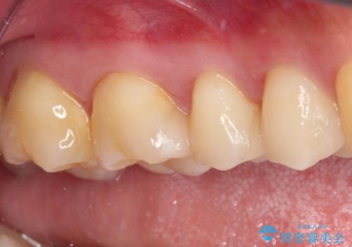 詰め物が外れた セラミックインレー修復の治療後