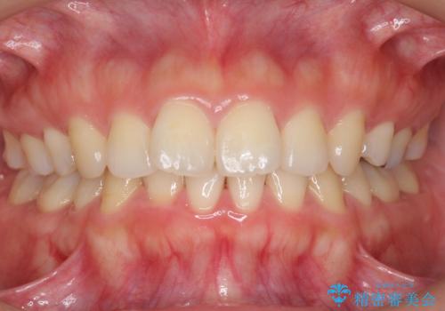 再矯正 昔ワイヤーで治療 前歯の並びを再度きれいにの症例 治療前