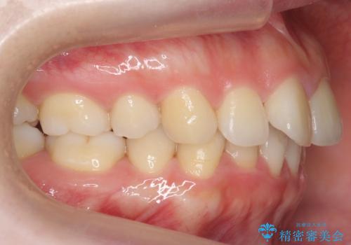 再矯正 昔ワイヤーで治療 前歯の並びを再度きれいにの治療前