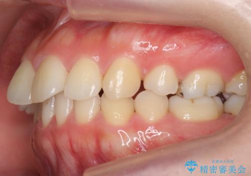 再矯正 昔ワイヤーで治療 前歯の並びを再度きれいにの治療前