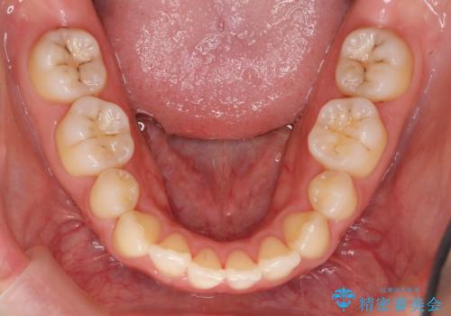 再矯正 昔ワイヤーで治療 前歯の並びを再度きれいにの治療前