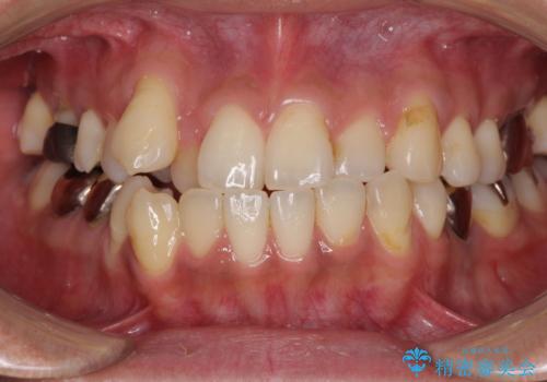 前歯のクロスバイトを改善　インビザライン矯正の症例 治療前
