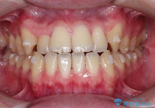 前歯のデコボコ インビザラインによる目立たない矯正の治療中