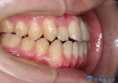 前歯のデコボコ インビザラインによる目立たない矯正の治療中