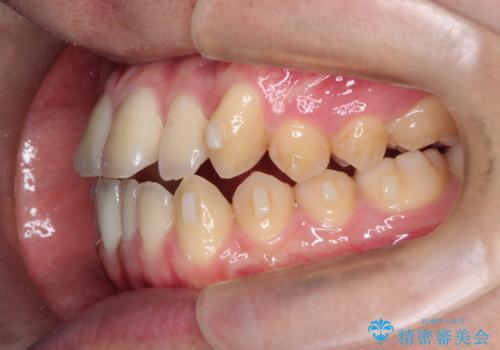 前歯のデコボコ　インビザラインによる目立たない矯正の治療中