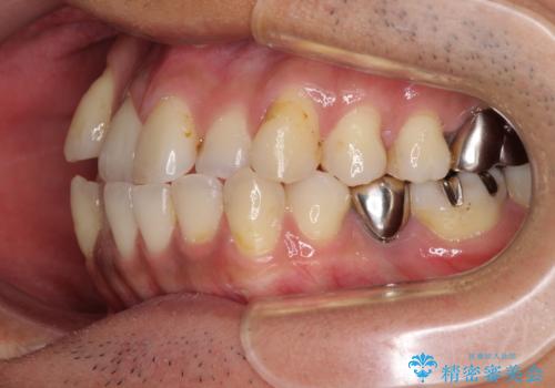 前歯のクロスバイトを改善　インビザライン矯正の治療前