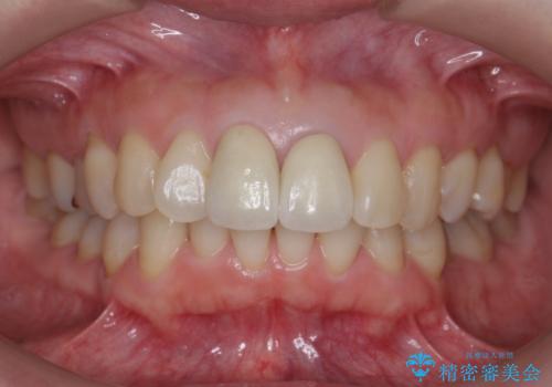 変色した前歯をセラミックでひっこめたい の治療後
