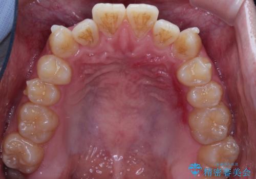 前歯のデコボコ　インビザラインによる目立たない矯正の治療中