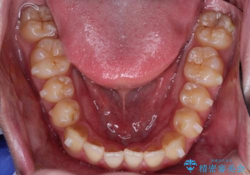 前歯のデコボコ インビザラインによる目立たない矯正の治療中