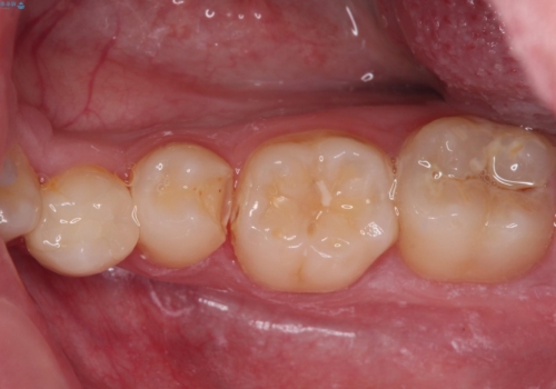 詰め物が欠けた セラミックインレーによる修復の治療前