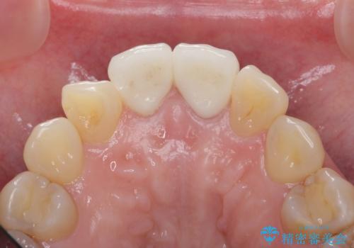 変色した前歯をセラミックでひっこめたい の治療後