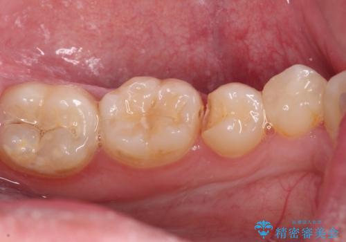 詰め物が欠けた セラミックインレーによる修復の治療前
