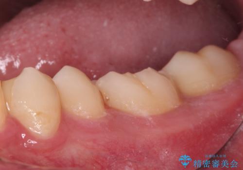 詰め物が欠けた セラミックインレーによる修復の治療前