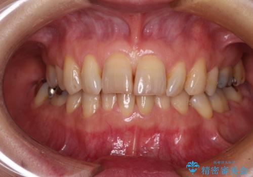 抜歯が必要と言われた前歯　根管治療とオールセラミッククラウンの治療後