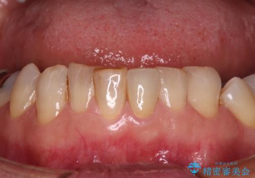 抜歯が必要と言われた前歯　根管治療とオールセラミッククラウンの症例 治療後