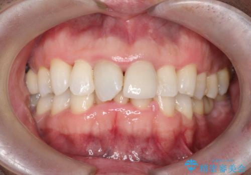 かけた前歯をきれいにしたいの症例 治療後