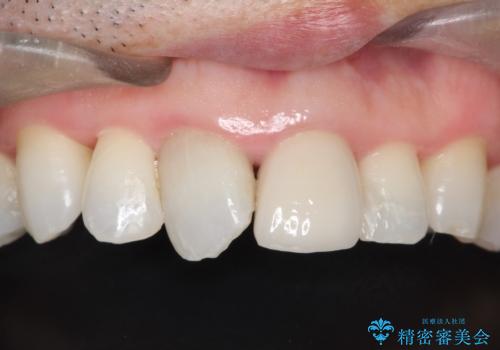 かけた前歯をきれいにしたいの治療後