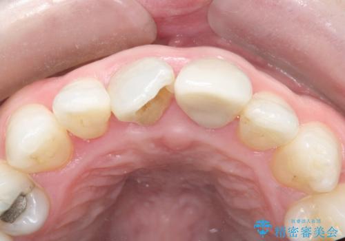 かけた前歯をきれいにしたいの治療後