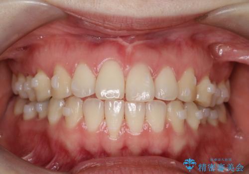上下の前歯がかめない インビザライン矯正で正しいかみ合わせへの治療中