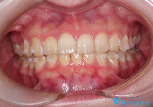 インビザラインで前歯のガタガタをきれいな歯並びへの治療中