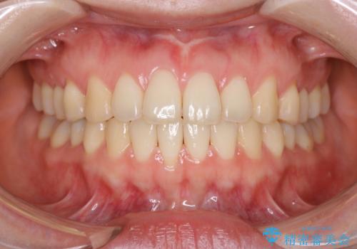 上下の前歯がかめない インビザライン矯正で正しいかみ合わせへの症例 治療後
