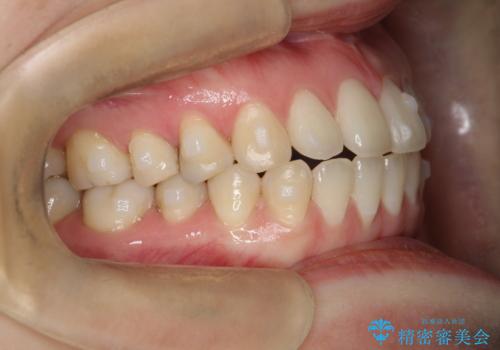 上下の前歯がかめない インビザライン矯正で正しいかみ合わせへの治療中