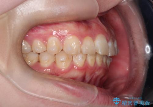 インビザラインで前歯のガタガタをきれいな歯並びへの治療中