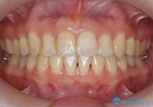 犬歯のねじれ　上の歯が引っ込んでいるの症例 治療後